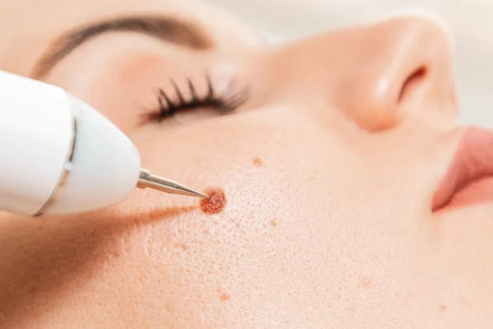 CRYOPEN FOR LESION REMOVAL