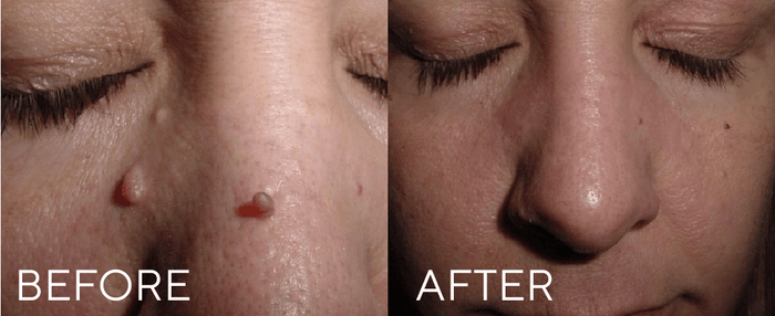 CRYOPEN FOR LESION REMOVAL