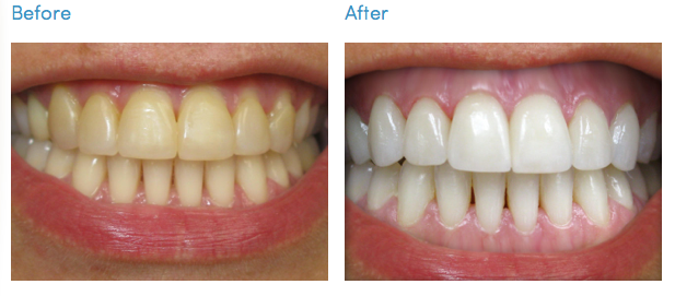 NEW Cyber SPECIAL Teeth Whitening on the Go!