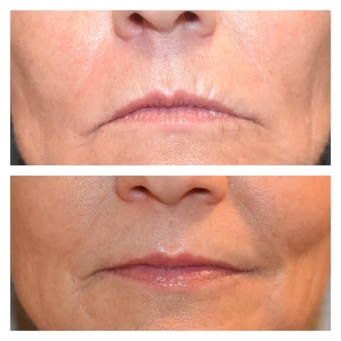 Skin Pen Micro-needling