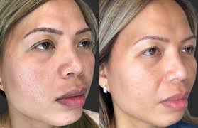 Skin Pen Micro-needling