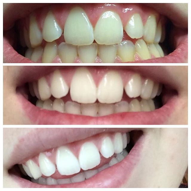 Sparkle White Teeth Whitening Kit w/Charcoal Toothpaste