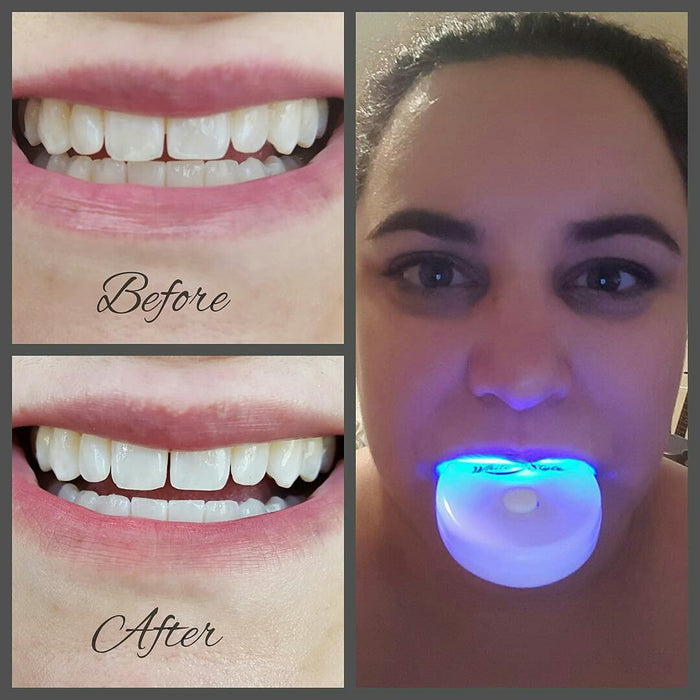 Sparkle White Teeth Whitening Kit