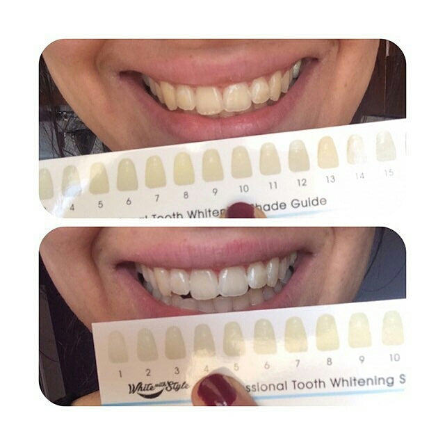 Sparkle White Teeth Whitening Kit