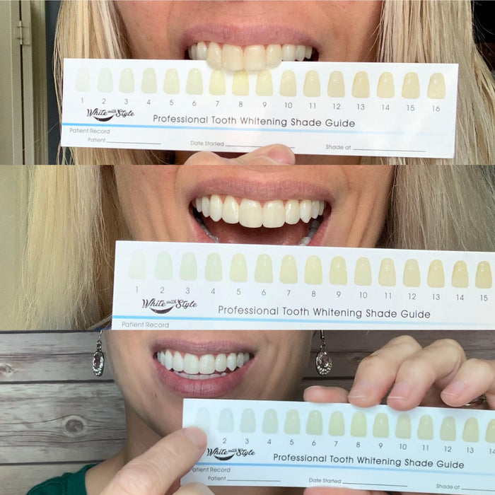 Sparkle White Teeth Whitening Kit
