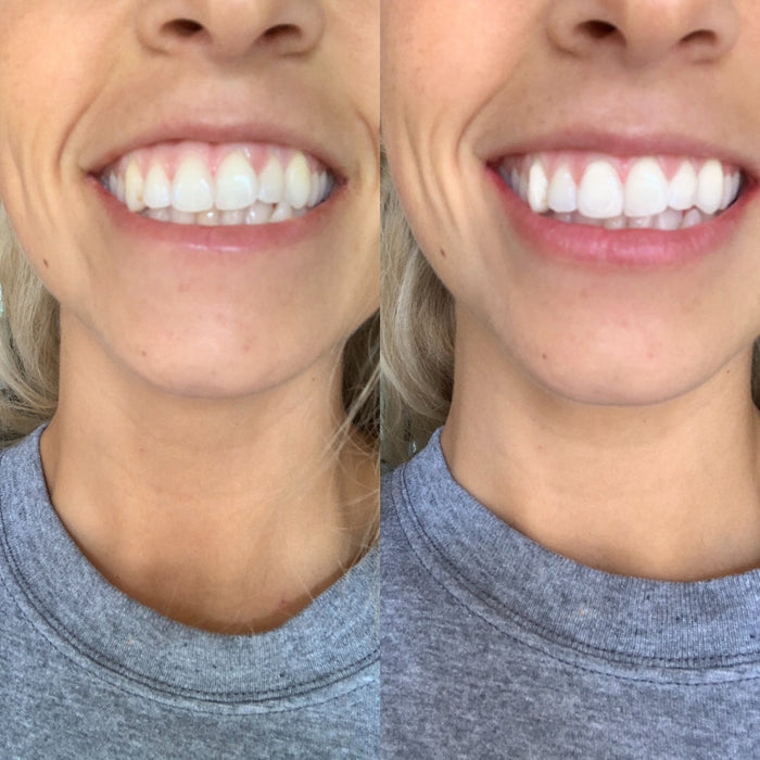 Stellar White Advanced Teeth Whitening Kit with Charcoal Toothpaste