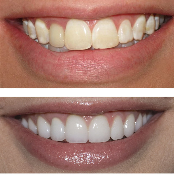 Summer Special Sparkle White Teeth Whitening Kit w/Free Gift